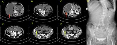 Case report: A rare case of synchronous mucinous neoplasms of the renal pelvis and the appendix